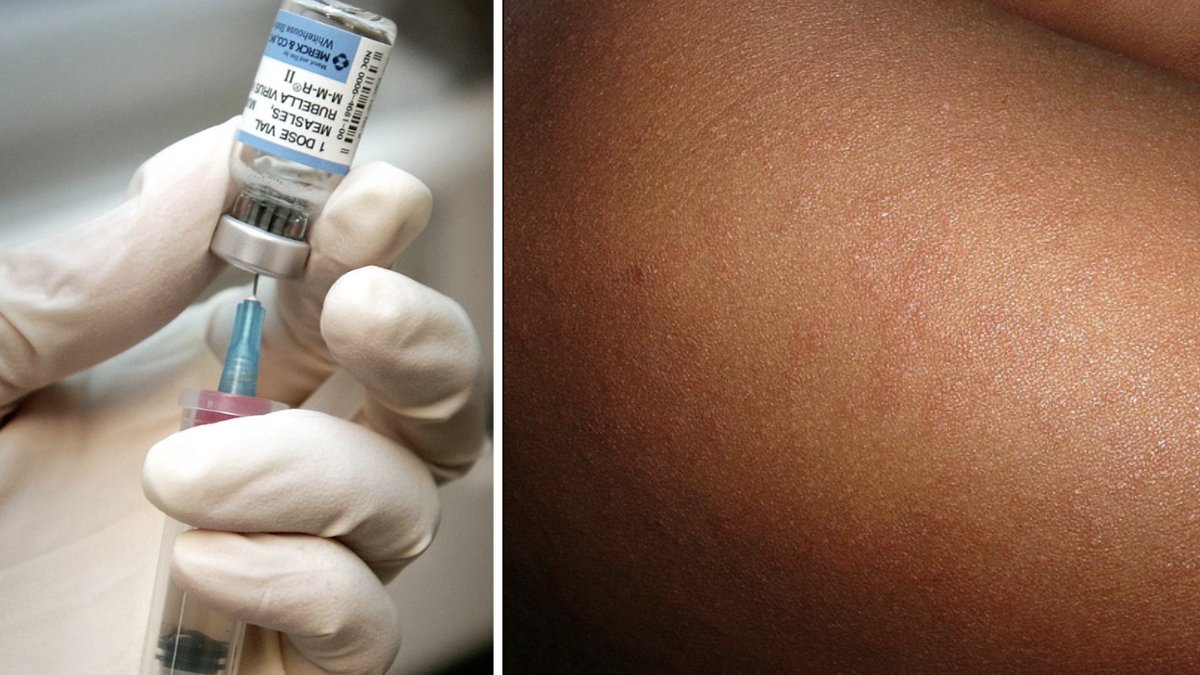 Vaccin, Mässling