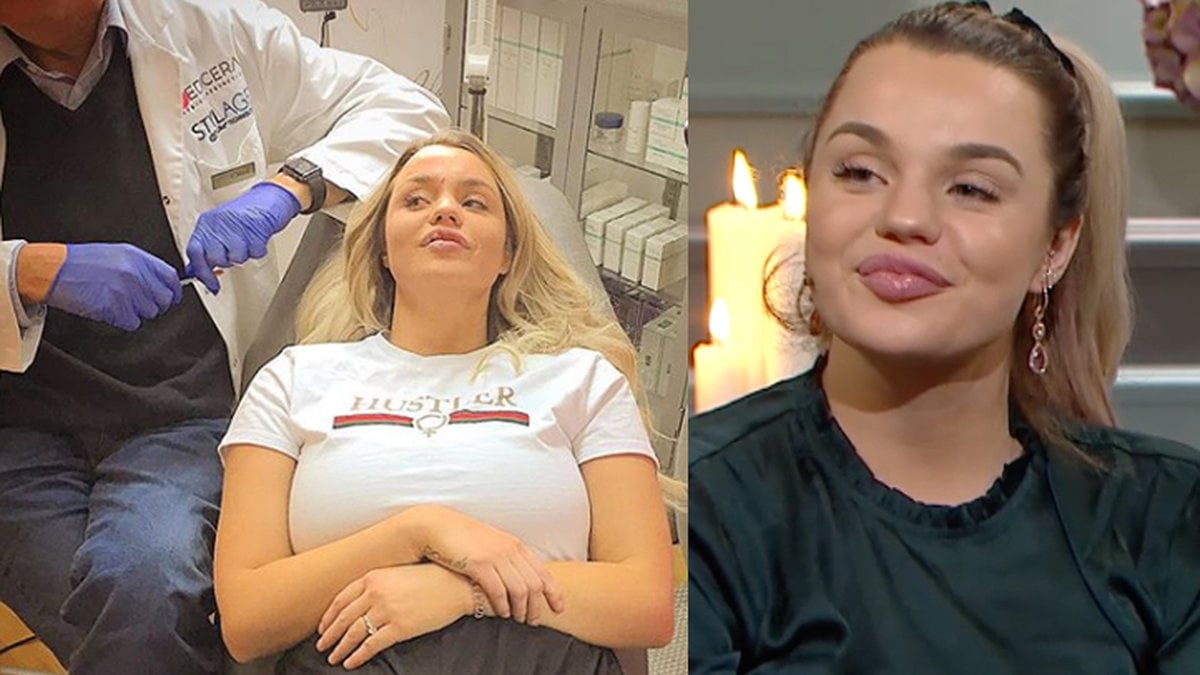 Jonna Lundell har använt fillers