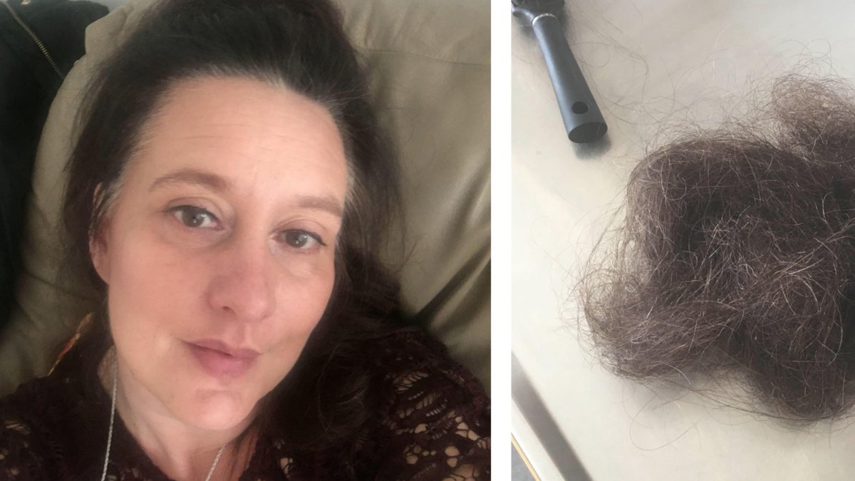 Carina drabbades av extremt håravfall