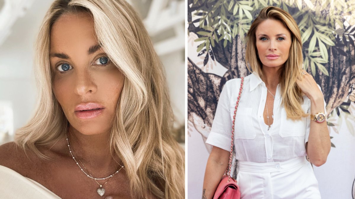 Carolina Gynning berättar om misslyckade skönhetsingreppet