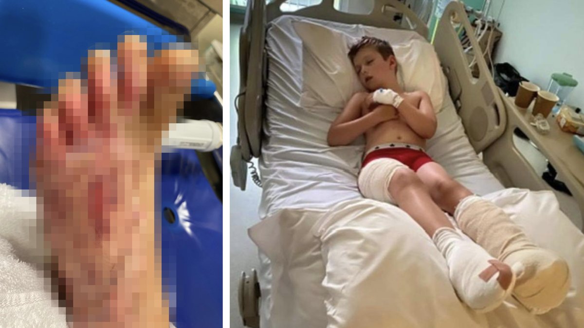 Will, 11, fick svåra brännskador efter dagen på stranden.