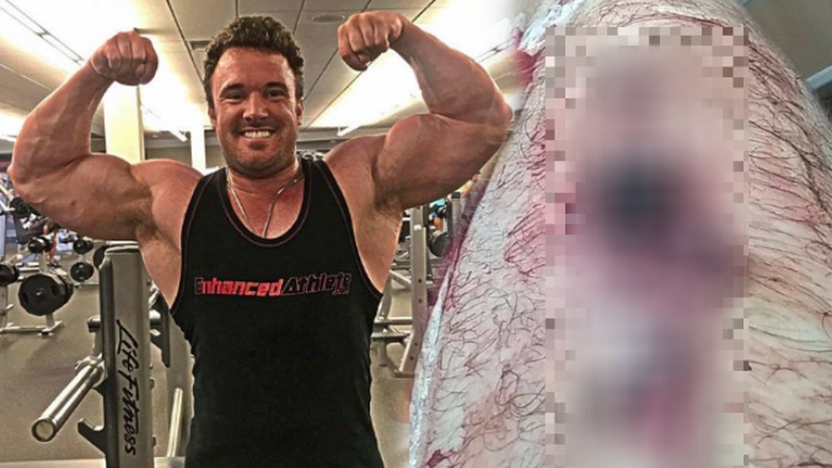 Bodybuilder Daniel och ett pixlat ruttet ben