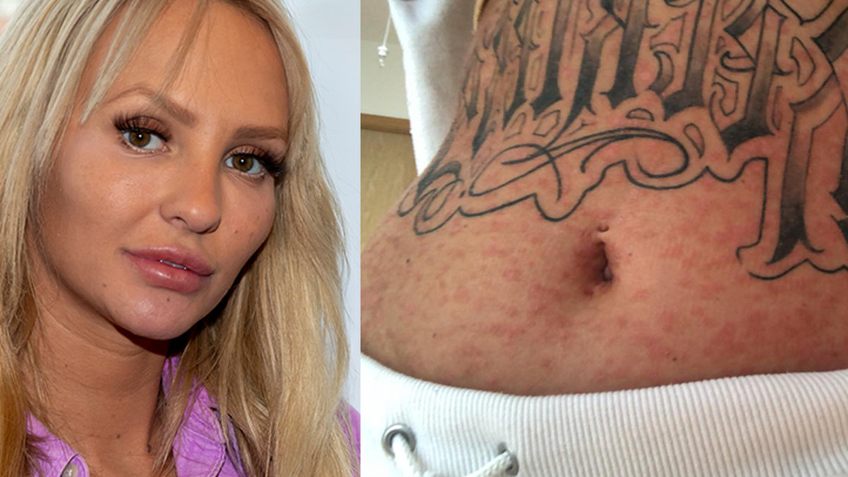 Paulina Paow Danielsson om sin psoriasis