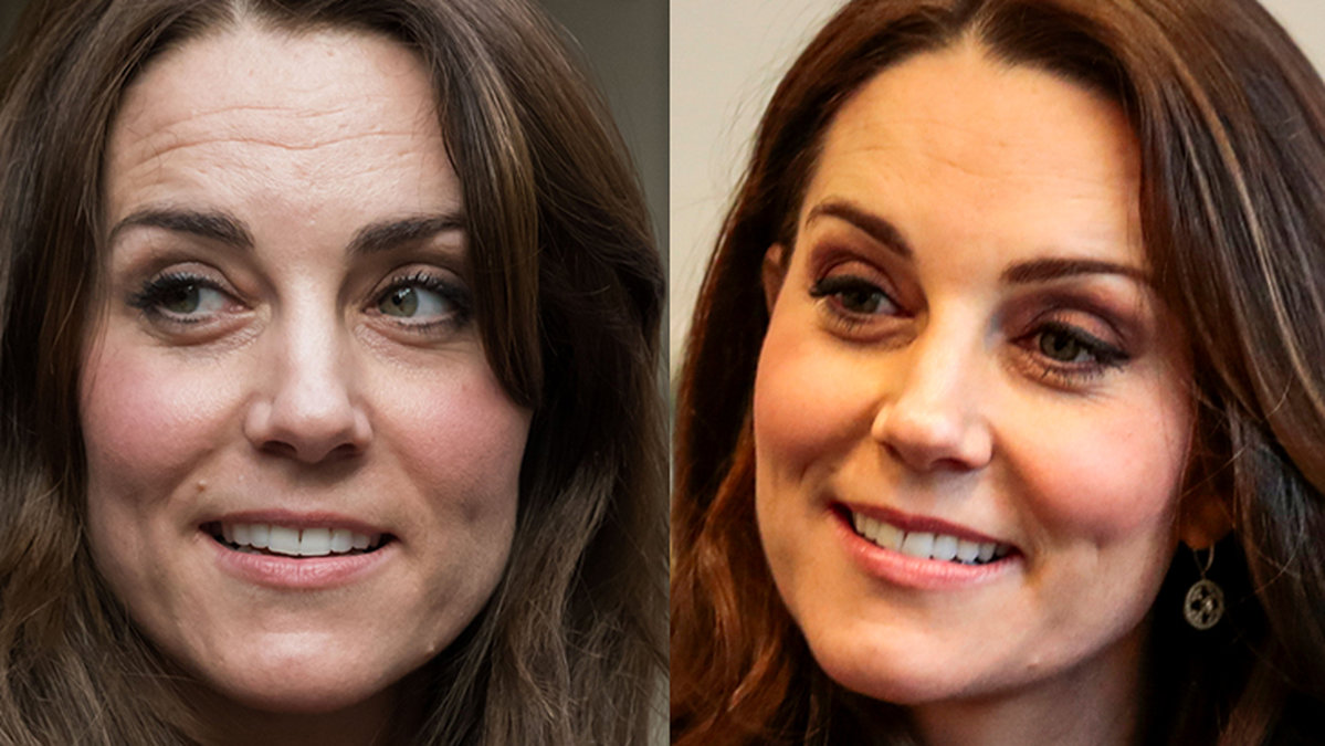 Kate Middleton Botox