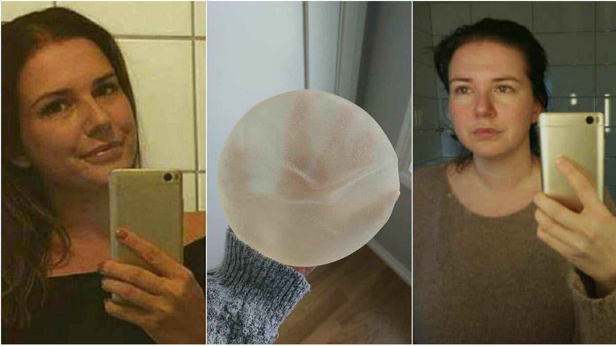 Susanna blev sjuk av sitt bröstimplantat
