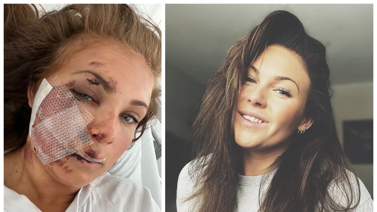 Linnéa Parra, 27, ramlade med en elsparkcykel på väg hem.