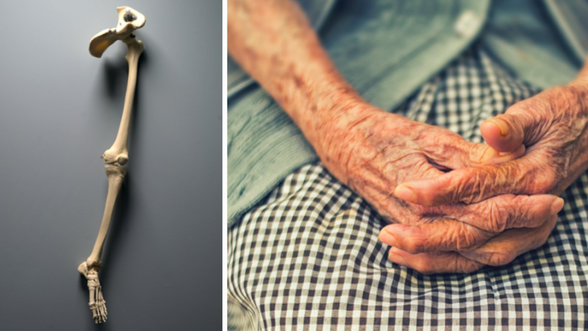 En äldre kvinna opererades på fel sida av höften på Södra Älvsborgs sjukhus.