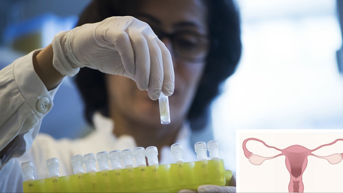 Forskare-kan-ha-hittat-orsak-till-endometrios