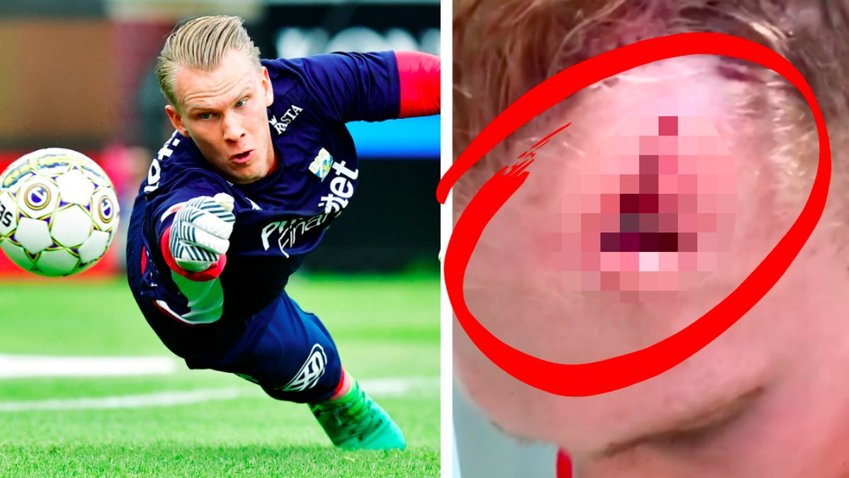 Pontus Dahlberg visar upp nya skadan. 