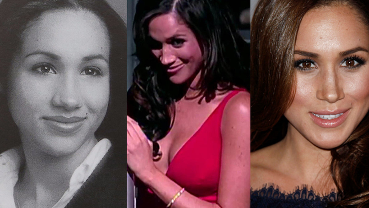 Har Meghan Markle gjort skönhetsoperationer.