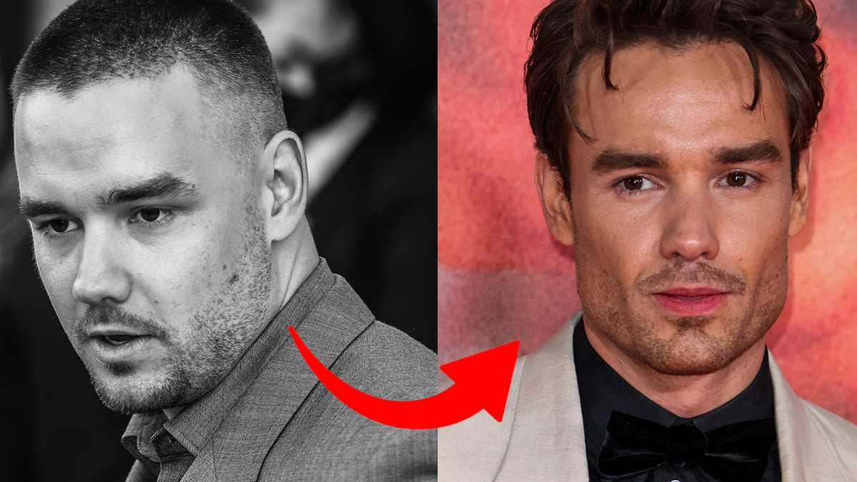 Liam Payne och buccal fat removal