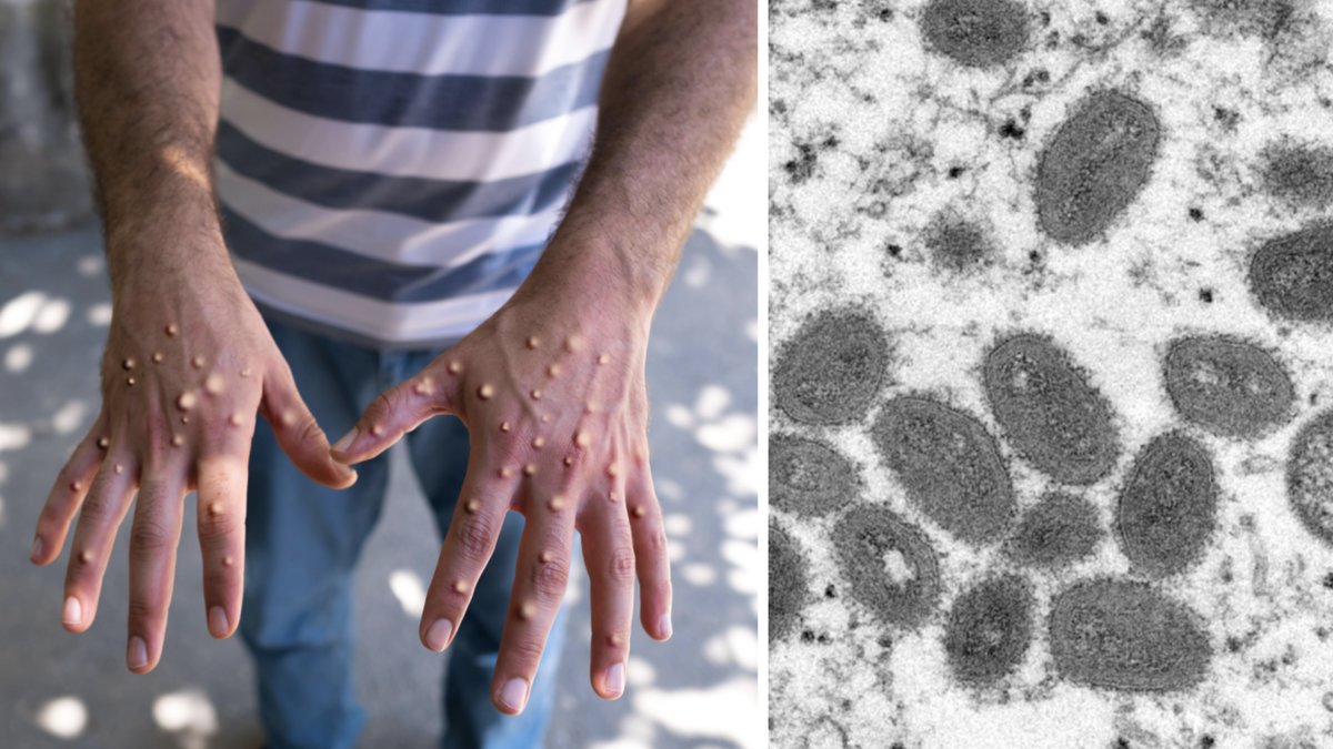 Under tisdagen meddelar FHM att Sverige kommer ta emot vaccin mot apkoppor