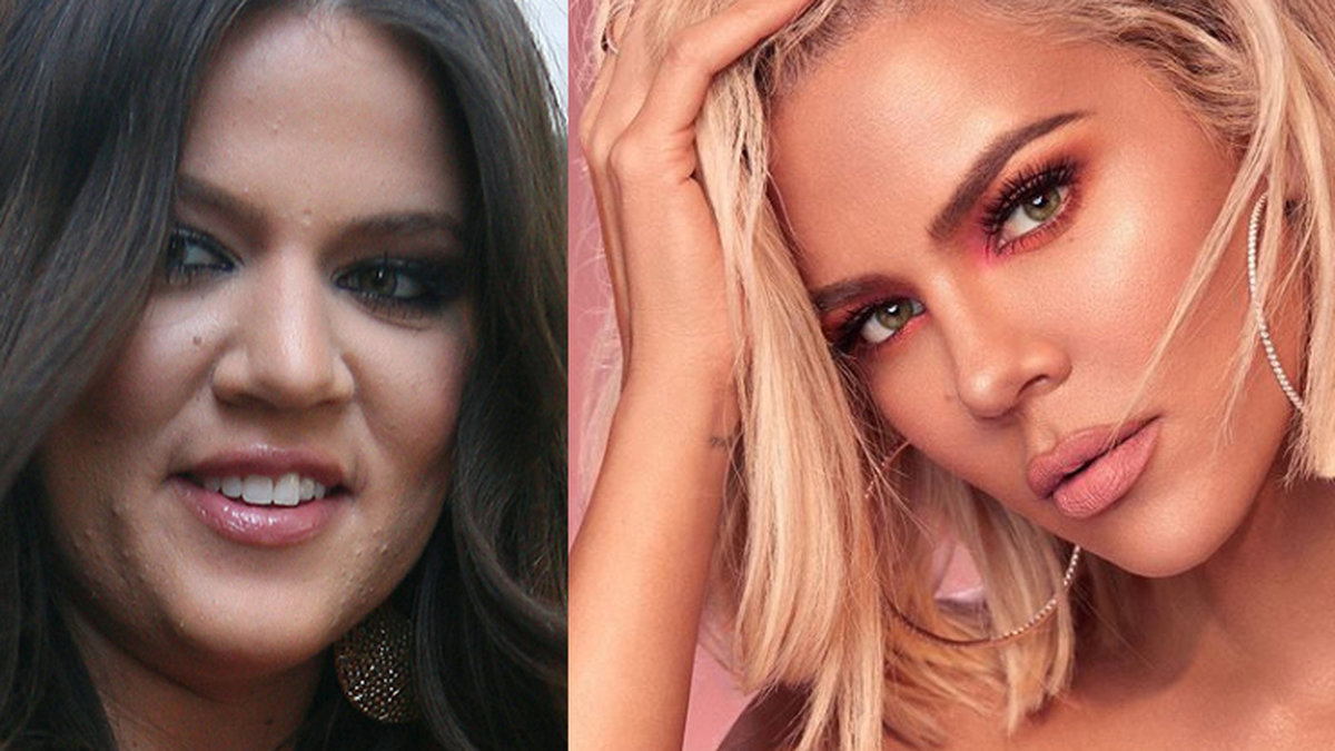 Khloé Kardashians nya operation