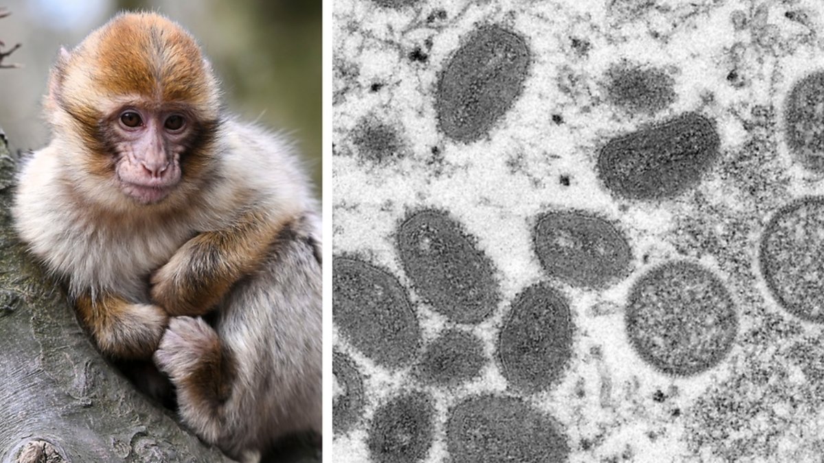 Ytterligare en person som smittats av apkoppor har avlidit.