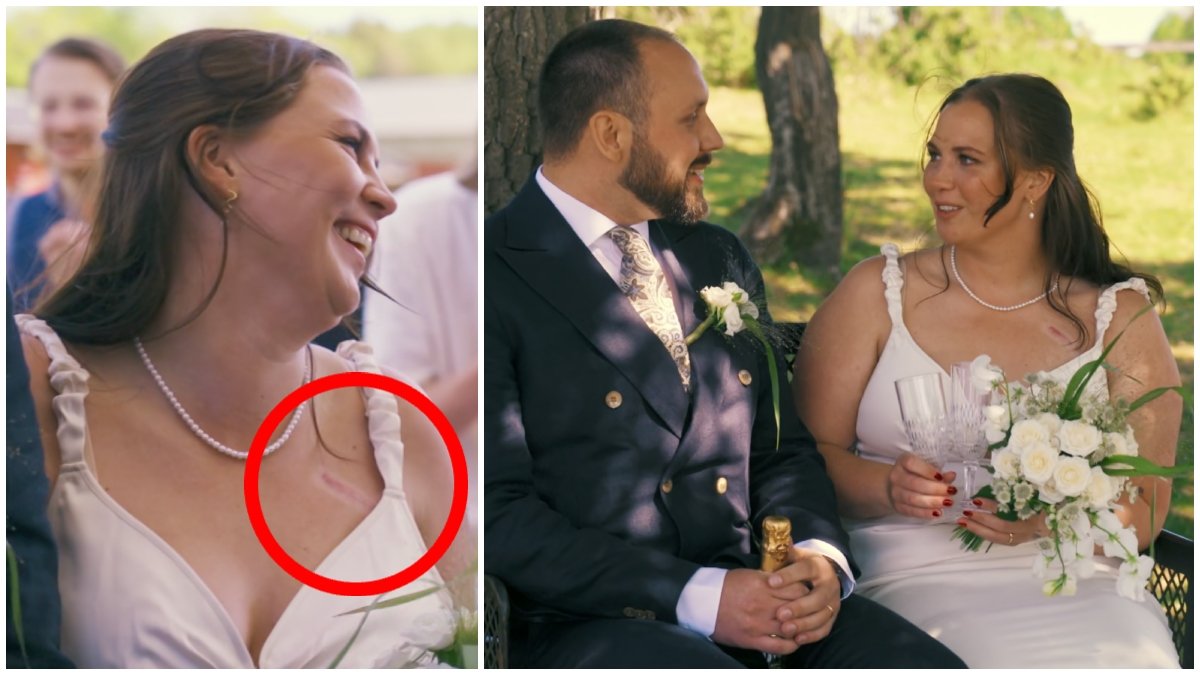 Linnea Alsberg i Gift vid första ögonkastet har, på sin Instagram, delat med sig av bakgrunden till det ärr hon har på bröstkorgen. 