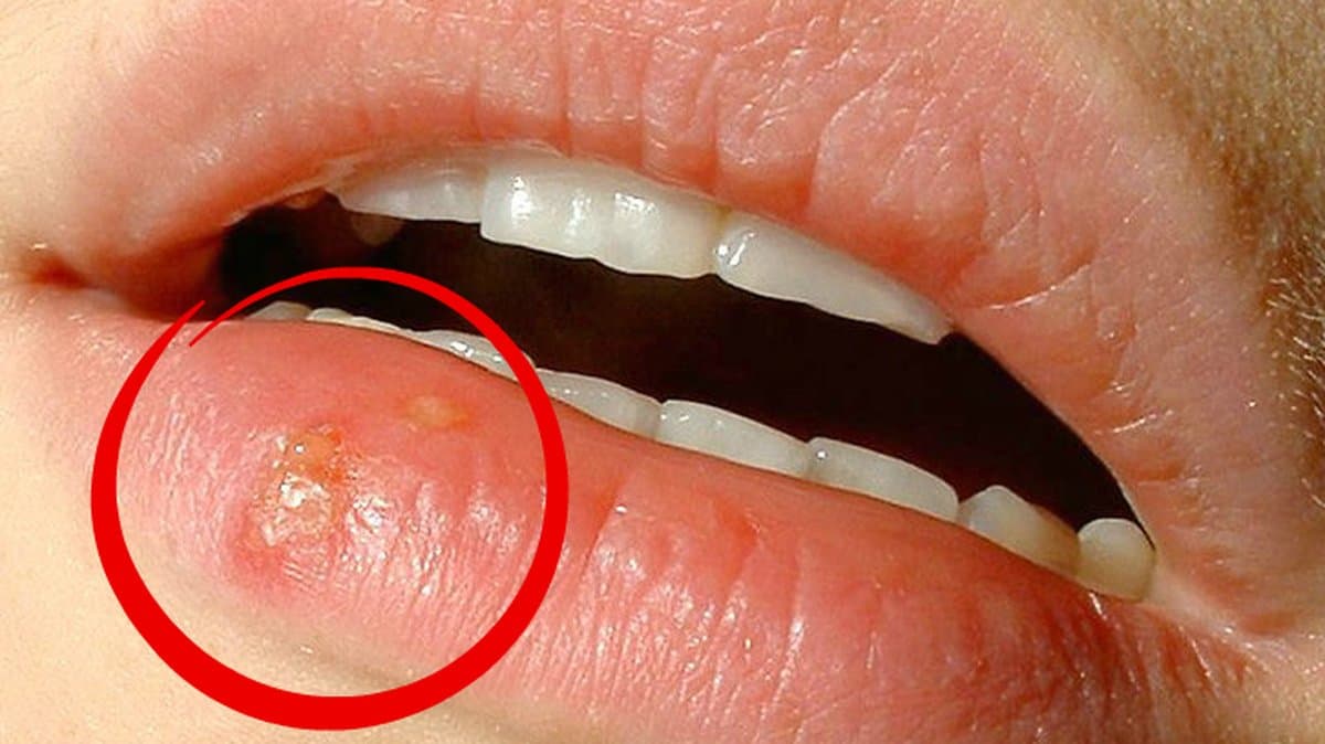 Alla-vet-hur-jobbiga-munsar-kan-vara