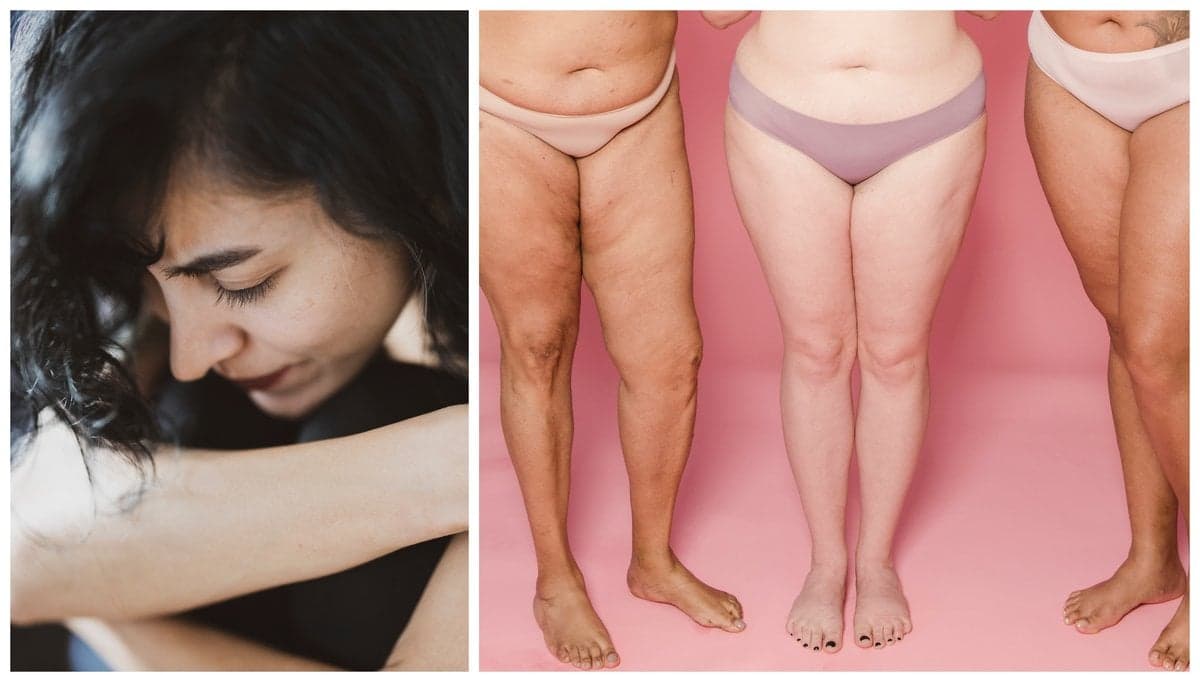 Tillståndet kallas i folkmun deprimerad vagina.