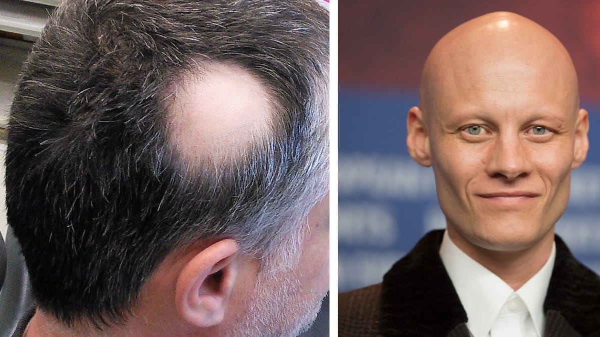 Alopecia kan innebära att håret faller av delvis eller helt.