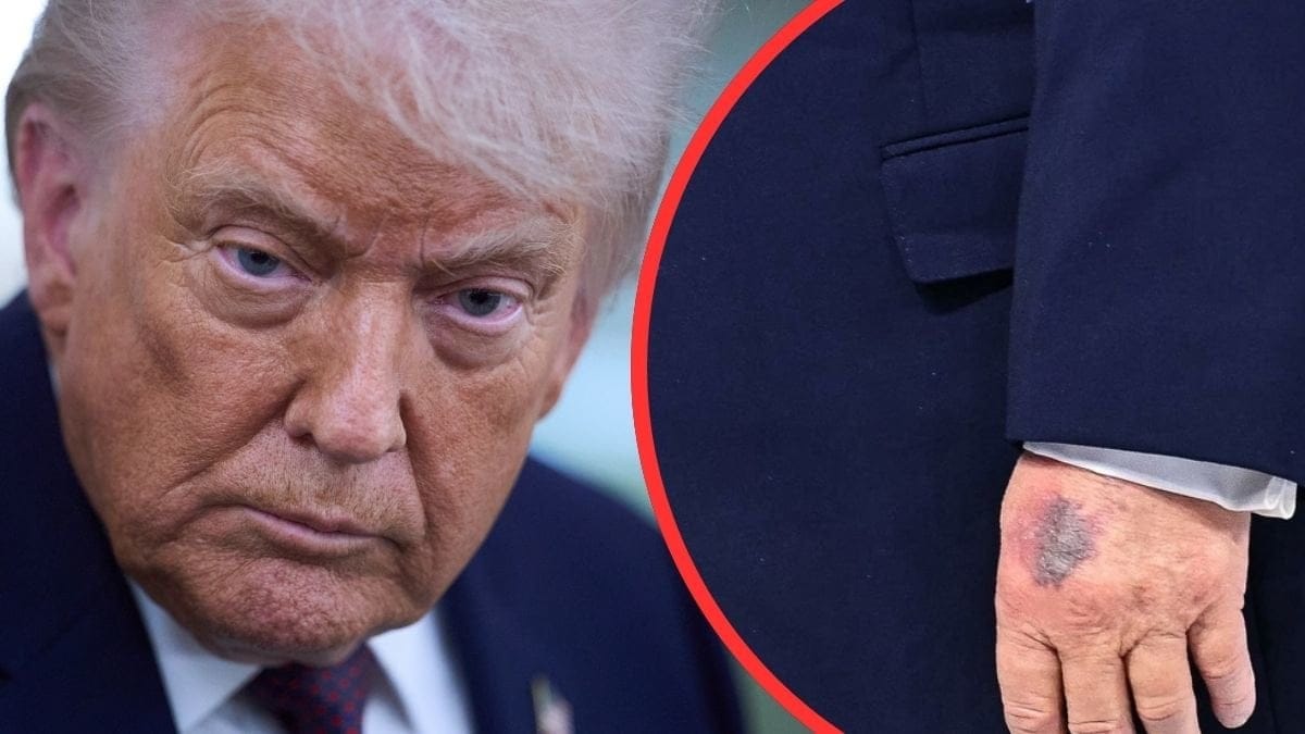 Donald Trump hand blåmärke