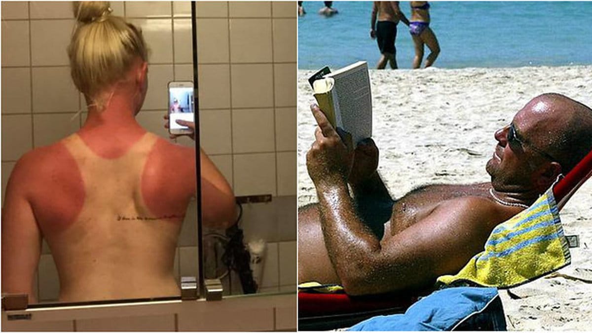 Här är de värsta solbrännorna 2017.