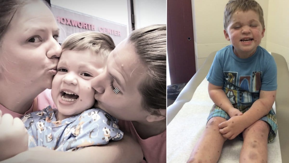 Dylan föddes täckt av födelsemärken.