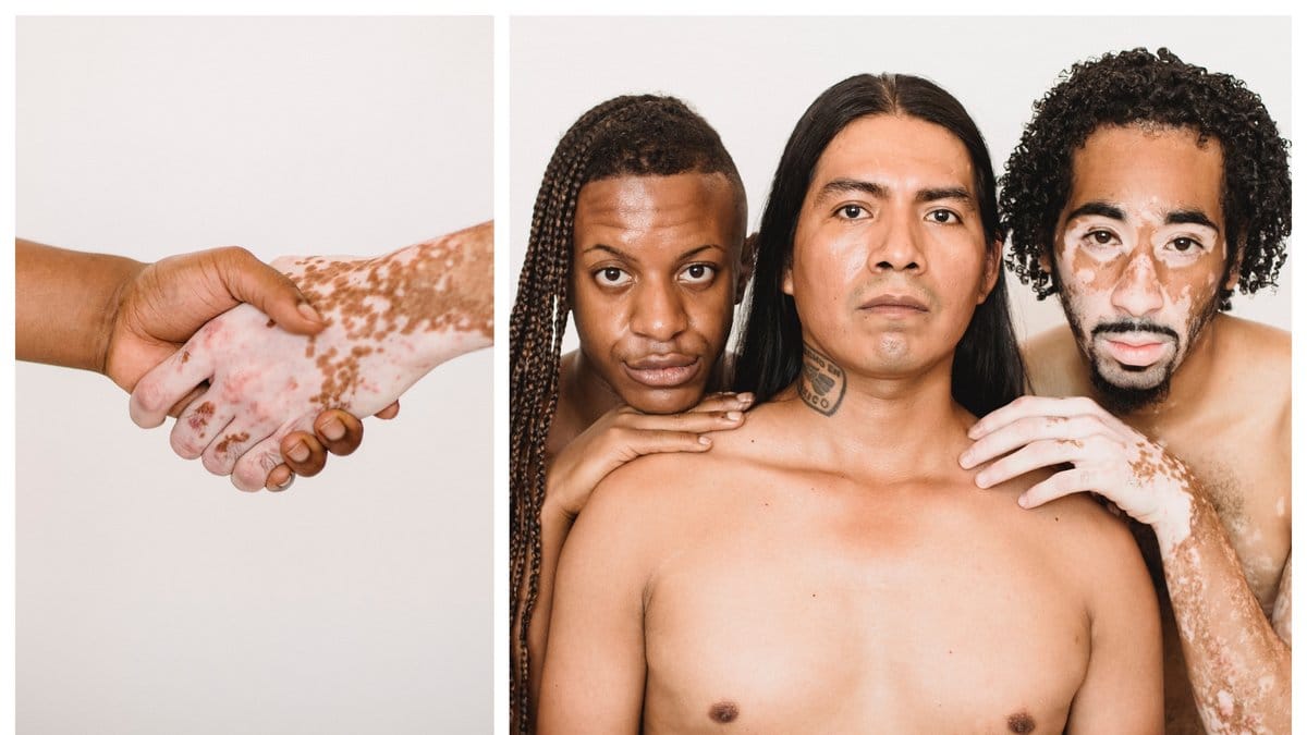 Nyheter24 reder ut allt om sjukdomen vitiligo.