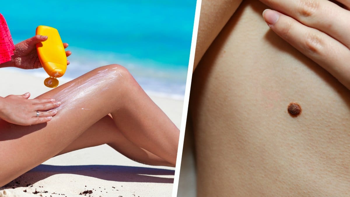 Här är listan på tecknen som kan tyda på hudcancer