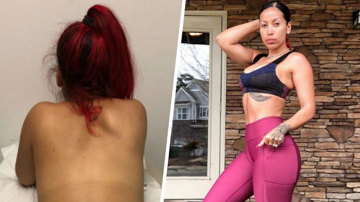 Jenelles la in silikon i rumpan – det slutade som en mardröm