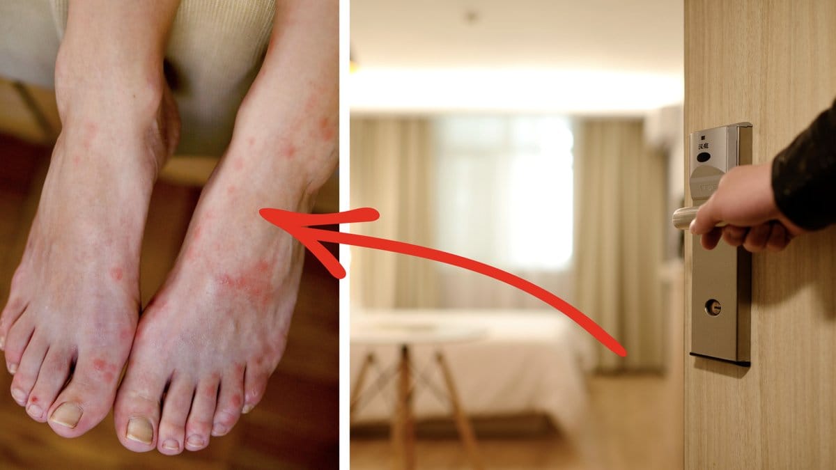 Många får med sig vägglöss hem från utlandsresan.