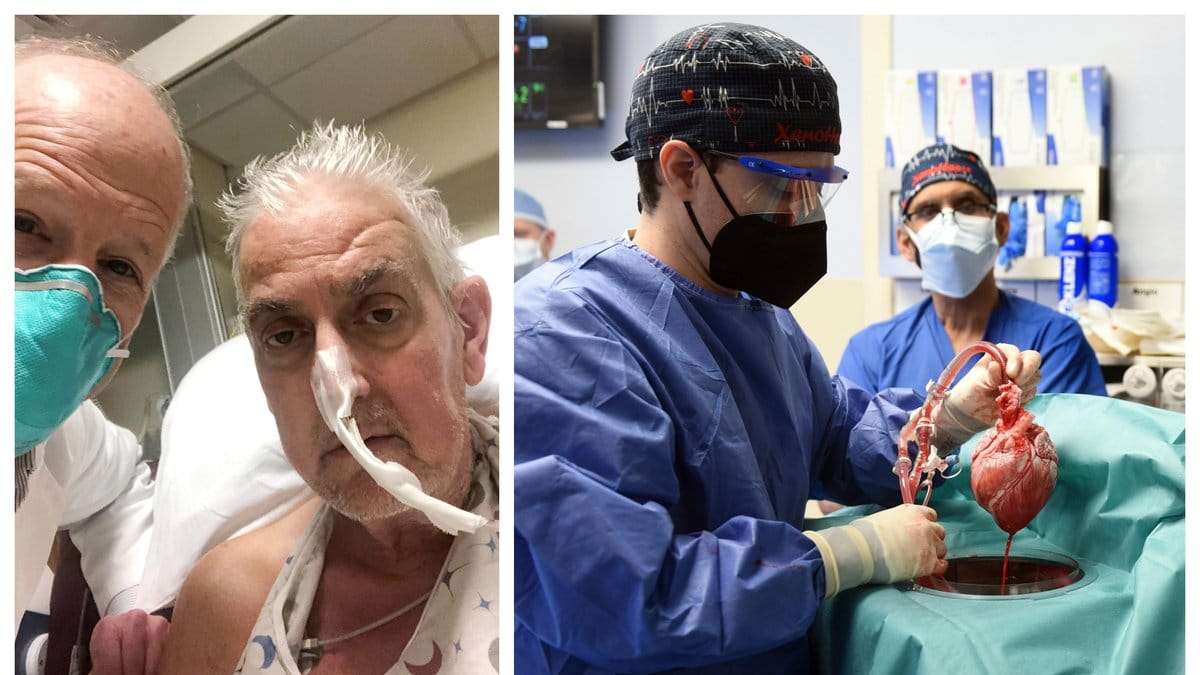 David Bennett, 57, har fått ett grishjärta.