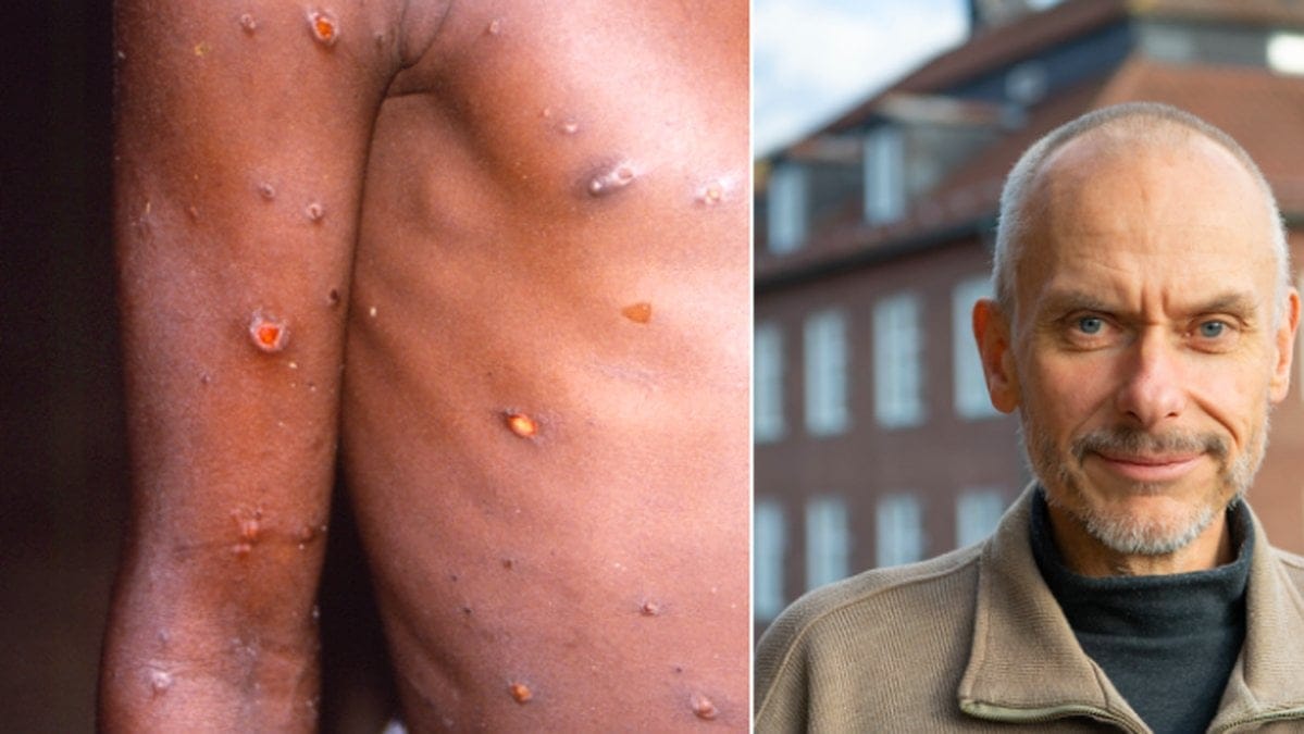 Överläkare Magnus Gisslén pratade med Nyheter24 om apkoppor.