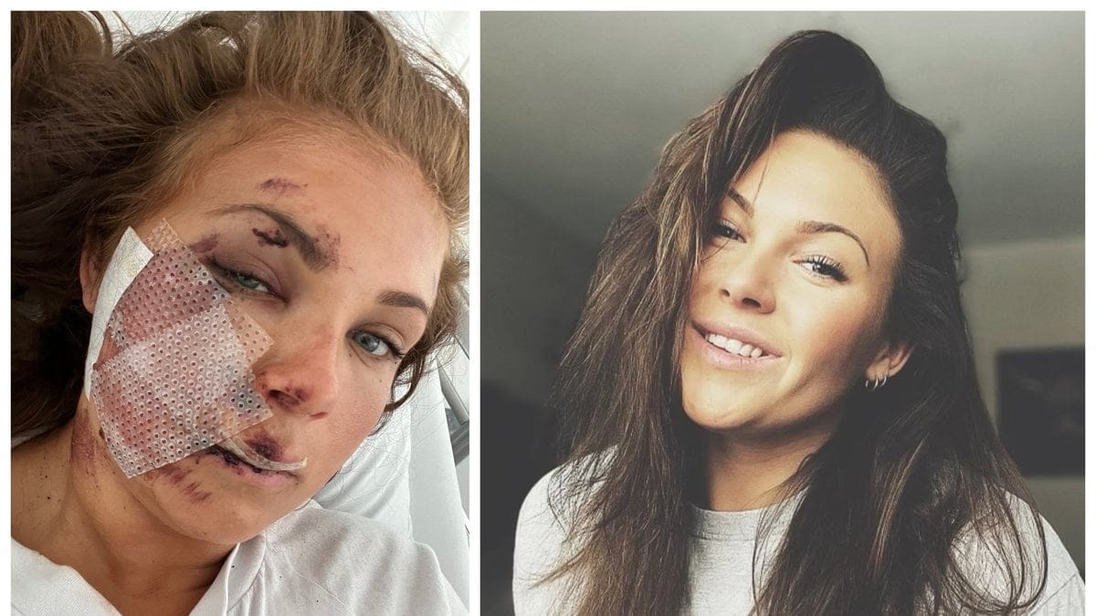 Linnéa Parra, 27, ramlade med en elsparkcykel på väg hem.
