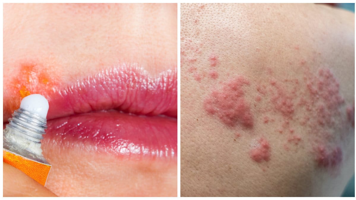 Herpes