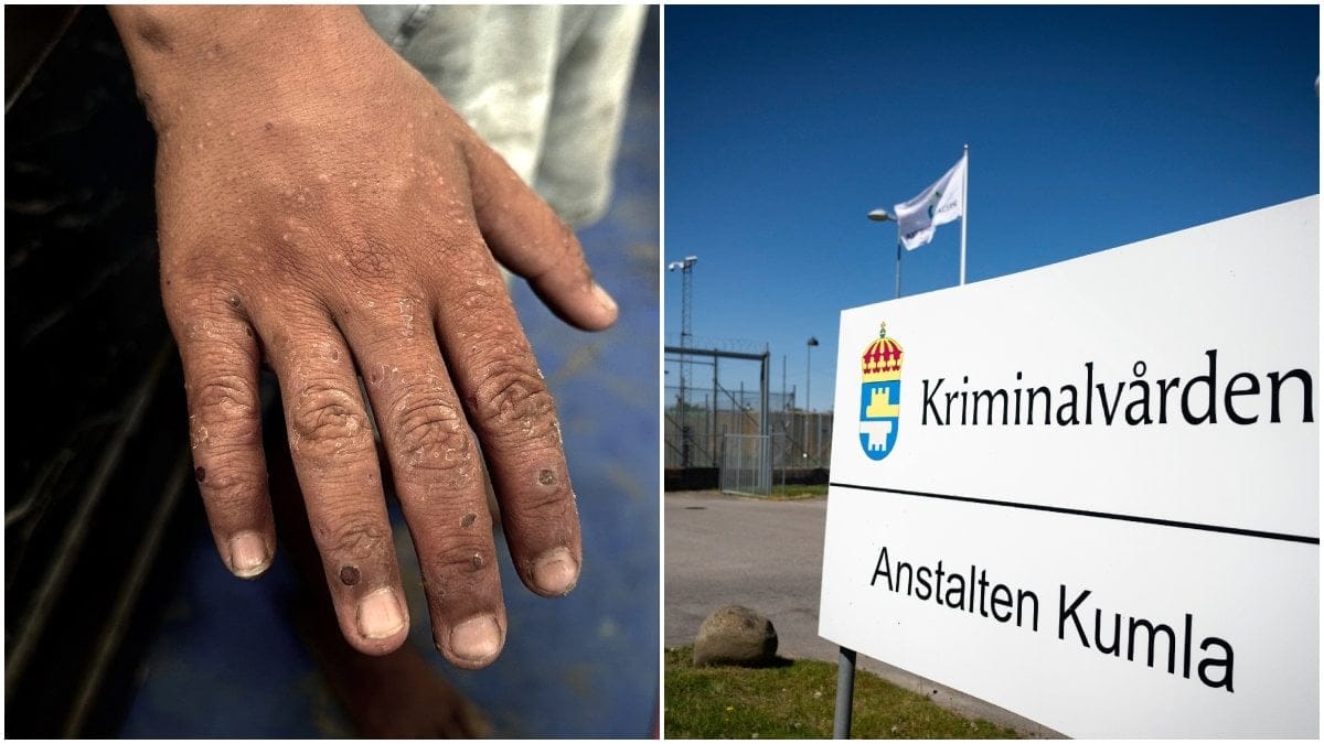 Kriminalvårdens anstalt i Kumla har säkerhetsklass 1. 30 fångar har nu fått hudsjukdomen skabb.