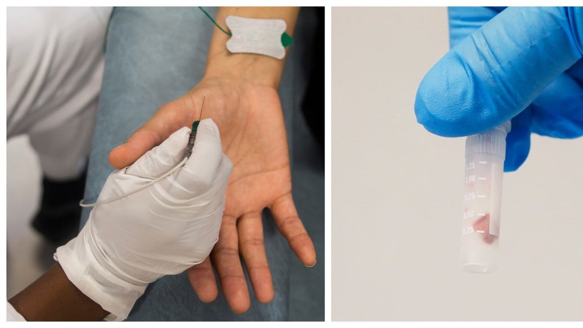 Ny metod: Prostatacancer kan behandlas effektivare.