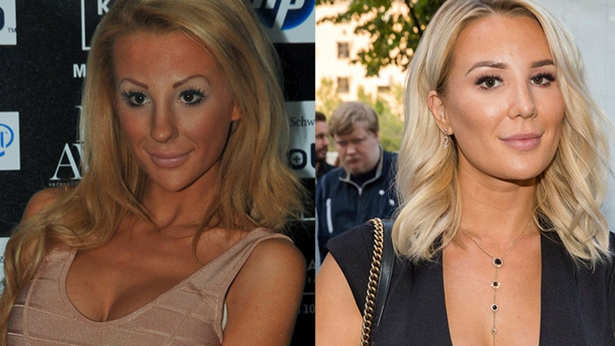 Alexandra Kissie Nilsson har tagit ut sina fillers.