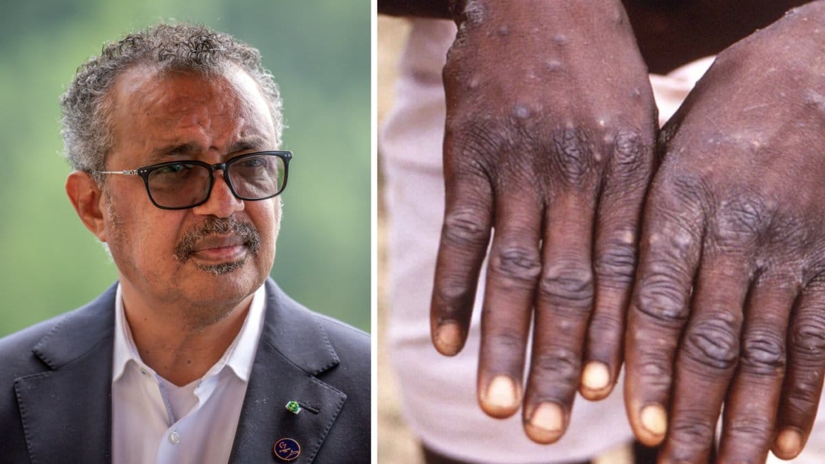 De vanligaste symptomen är bland annat blåsor eller sår på armar, ben, händer och fötter.