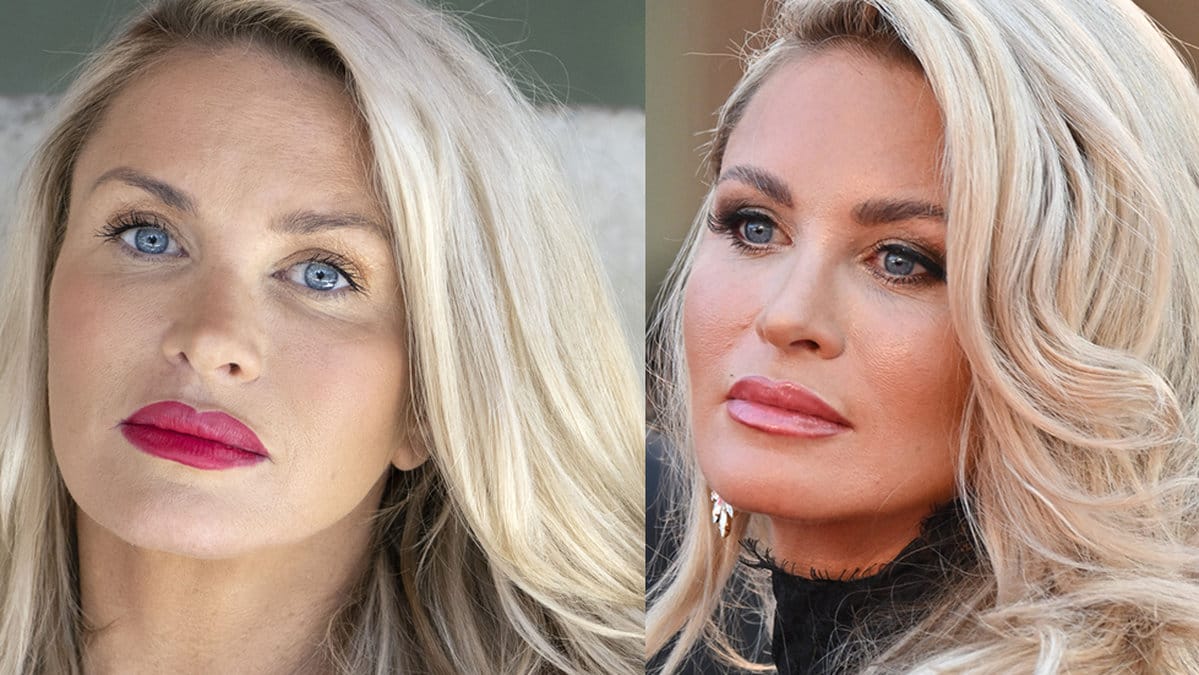 Carolina Gynning möttes av kritik efter att hon opererat brösten.