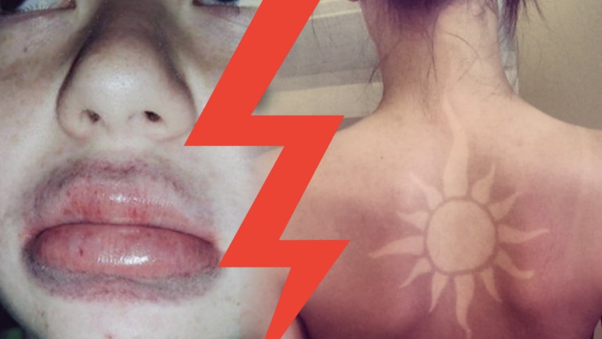Sunburn art – farlig skönhetstrend