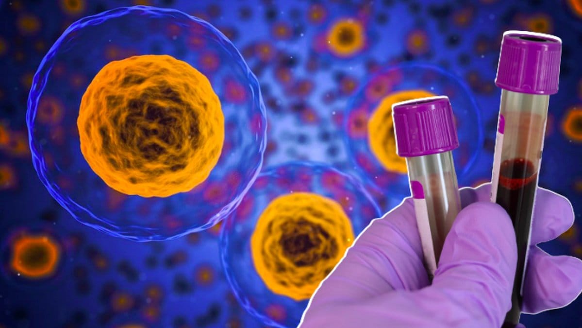 Det forskas mycket kring blodprov för att upptäcka cancer i tidigt skede.