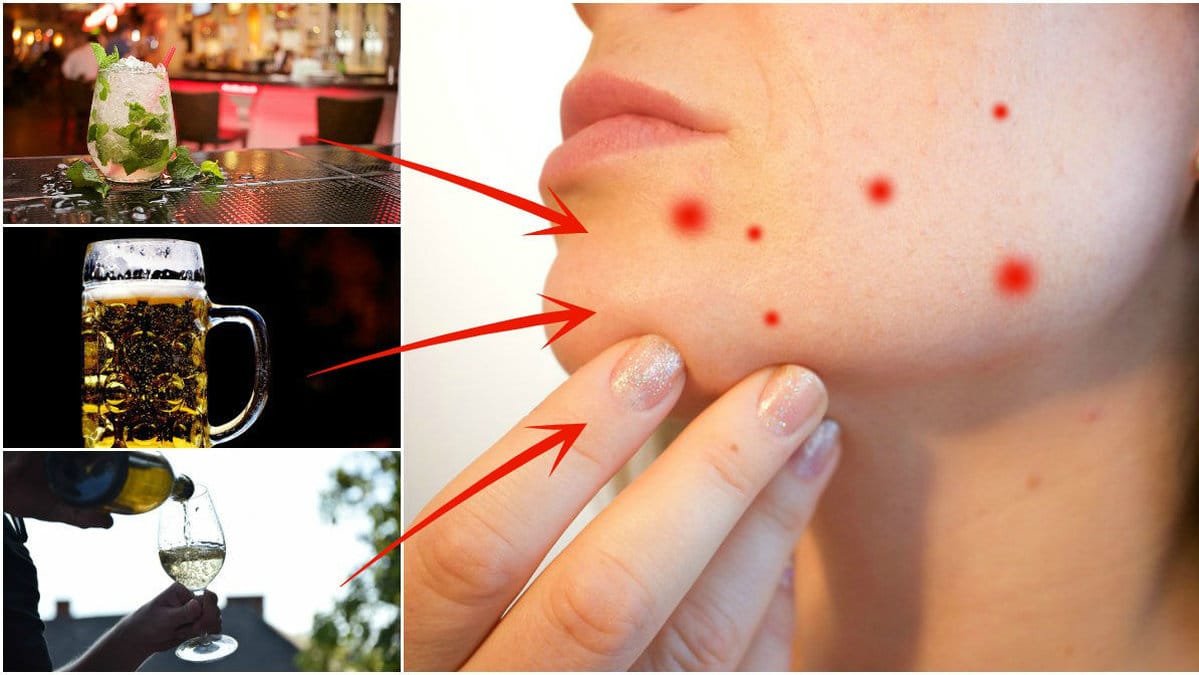 Hy, acne, alkohol 