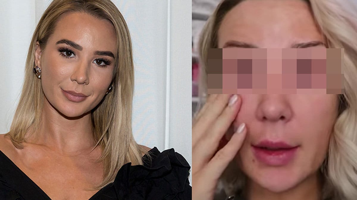  Alexandra Kissie Nilsson har drabbats av ögoninflammation.